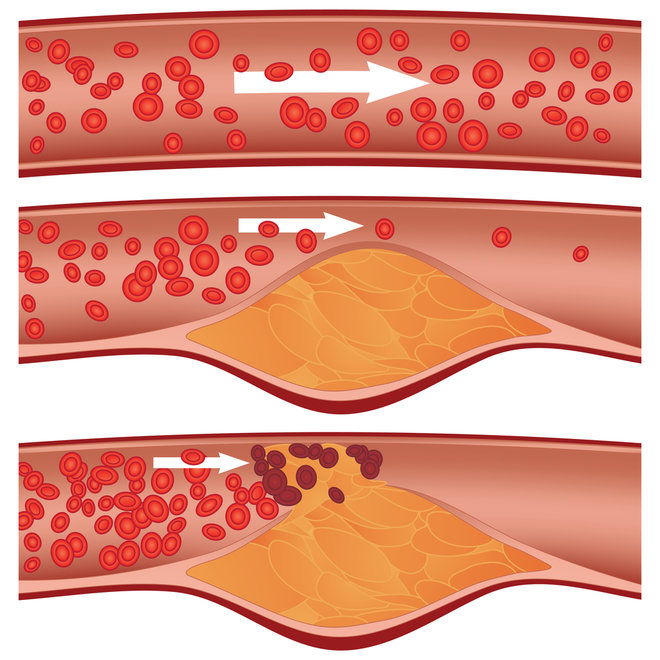 cholesterol - ateroskleroza